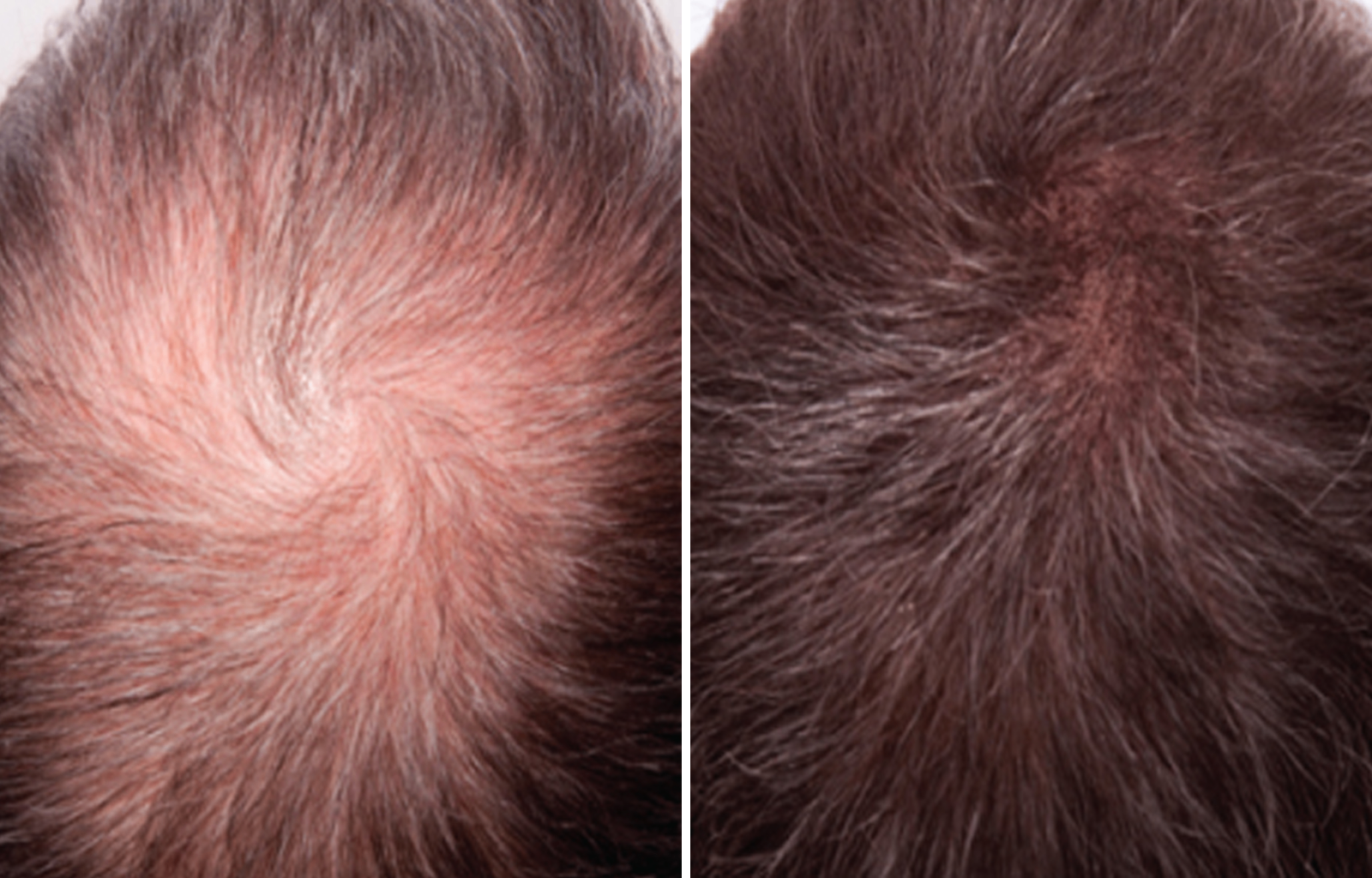 Before and after — James W., 34 · Crown thinning