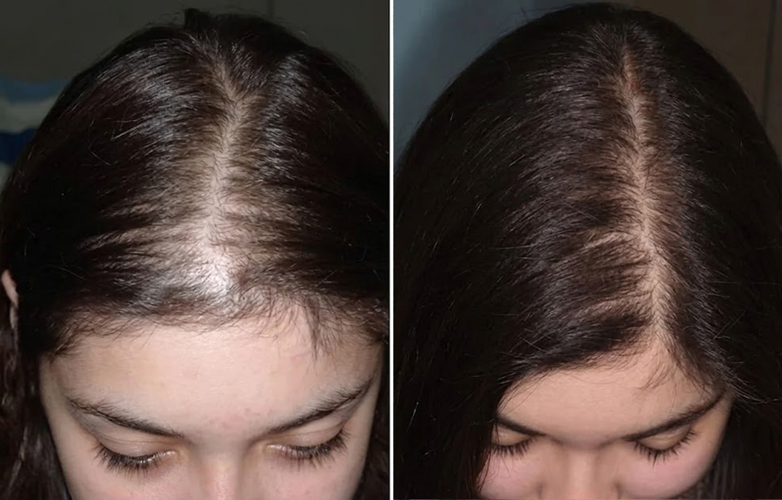 Before and after — Priya S., 37 · Wide parting