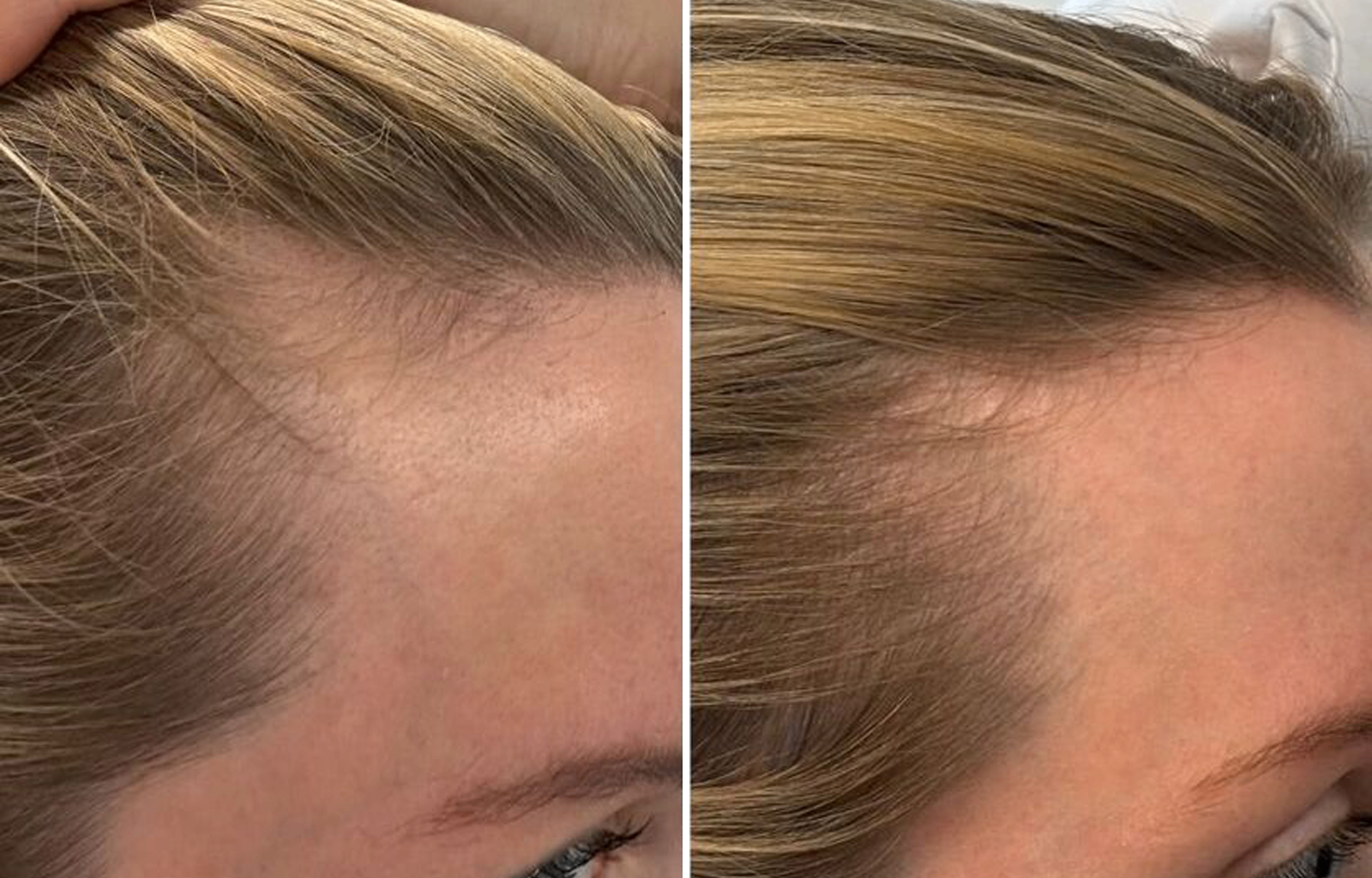 Before and after — Mara L., 41 · Diffuse thinning
