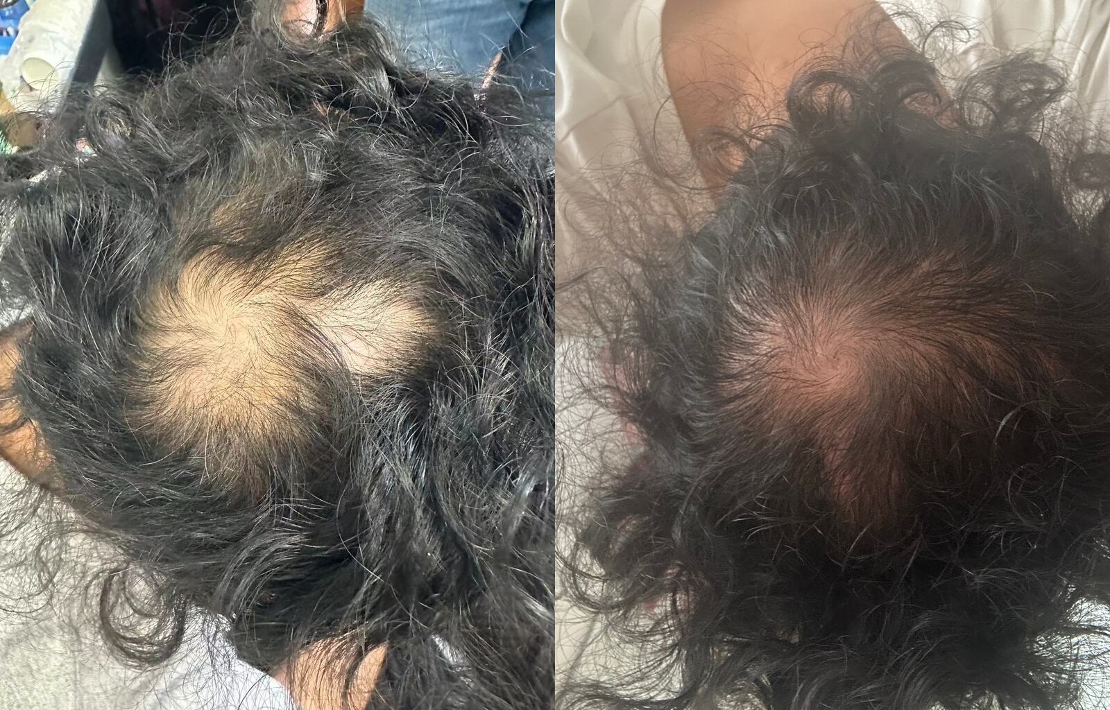 Rami Hattoum, founder of Soraderma — before and after 16 weeks on the micro-infusion protocol